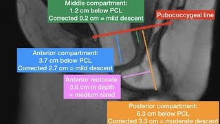 MRI Defecogram Proctogram [upl. by Gifferd529]