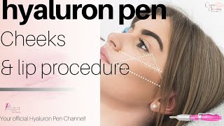 Lips amp Cheeks Filler Hyaluron Pen [upl. by Kemppe]