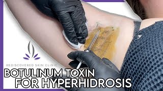 Botulinum Toxin For Hyperhidrosis  Rediscovered Skin Clinic [upl. by Rydder701]