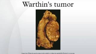 Warthins tumor [upl. by Vaclav786]