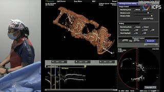 Left main and complex bifurcation stenting  EuroPCR 2024 [upl. by Hertzog382]