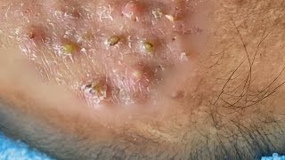 Big Cystic Acne Blackheads Extraction Blackheads amp Milia Whiteheads Removal Pimple Popping 059 [upl. by Tamma]