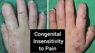 Congenital insensitivity to pain 💔 explained [upl. by Pizor63]