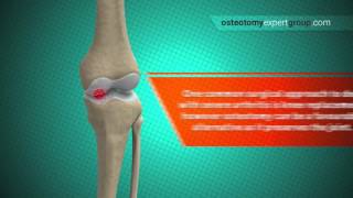 Osteotomy Animation i [upl. by Harriette]