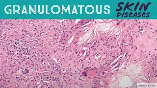 Granulomatous Skin Diseases 101 Dermpath Basics for Dermatology Pathology amp USMLE [upl. by Merissa]