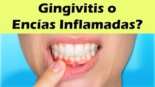 COMO CURAR LA GINGIVITIS Remedios Caseros Para La Gingivitis y Encías Inflamadas [upl. by Erasmo]