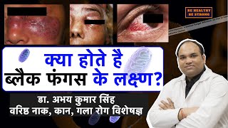 Coronavirus MucormycosisBlack Fungus Symptoms in Hindi Dr Abhay Kumar Singh SrENT Consultant [upl. by Oirad]