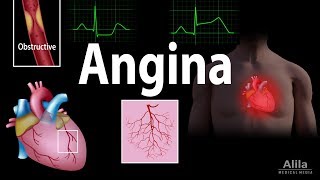 Angina Stable Unstable Microvascular and Prinzmetal Animation [upl. by Kilian]