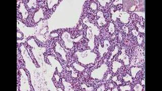 Histopathology Lung Interstitial pneumonia [upl. by Luahs292]