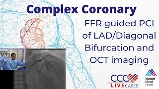 FFR guided PCI of LADDiagonal Bifurcation and OCT imaging  CCC Live April 2016 [upl. by Alithea]