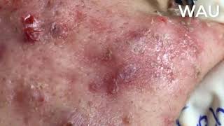 Squeeze acne  acne hidden under the skin  part 5 [upl. by Naara]