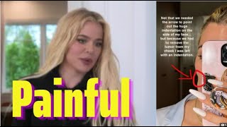 Khloe Kardashian revealed her disfigured face with extremely scary injuries [upl. by Ahsyla584]