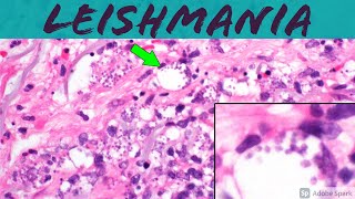 Leishmaniasis Leishmania Infection 5Minute Pathology Pearls ‪Dermatology Dermatopathology [upl. by Ettena]