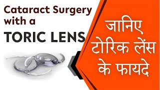 Toric lens astigmatism correcting intraocular lens Toric IOL amp Cataract  मोतियाबिंद में टोरिक लेंस [upl. by Oetsira]