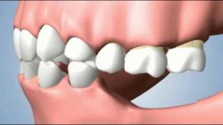 How To GROW BONE Lost To Gum Disease  AMAZING Results [upl. by Gelhar813]