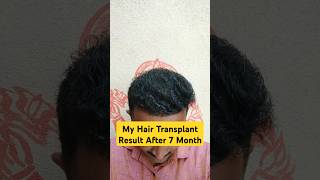 Day 200  My Hair Transplant Result hairloss haircare haireducation haircut myhairtransplant [upl. by Roht]