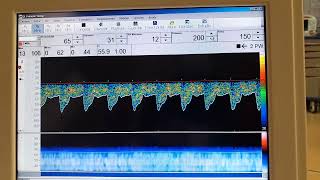 Doppler transcraneal convencionalArteria Basilar [upl. by Fabyola581]