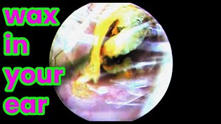 asmr ear cleaning  wax in your ear  Ear health  ear piercing cleaning how to unclog your ear [upl. by Yob]