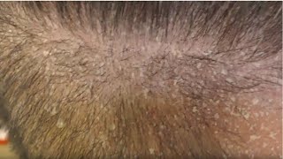 SCALP PSORIASIS FLAKING ALLOVER [upl. by Esydnac]