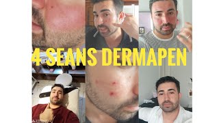 4 Seans Dermapen Cilt Bakımı Süreci dermapen yüzbakımı ciltbakımı peeling [upl. by Eveneg]