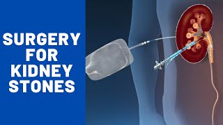 Surgery For Kidney Stones  How long does it take to recover from kidney stone surgery  247nht [upl. by Rapsac]