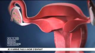 Infertilité féminine  de la stimulation à la fécondation [upl. by Riegel]