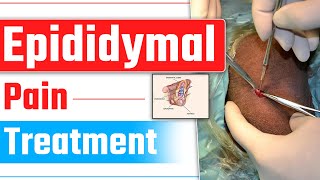 Varicocele or Epididymal Cyst  Epididymal Pain Treatment  Dr Health [upl. by Ihel]