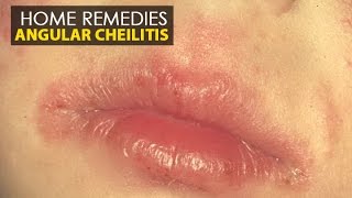 Angular Cheilitis  Home Remedies Natural Treatment  Health Education [upl. by Etam819]