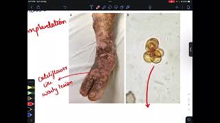 Mycology 3 mycetoma chromoblastomycosis pneumocystis jeroveci fmge2023 mbbs microbiology [upl. by Carmelia786]