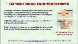 Angular Cheilitis NHS  BestAngularCheilitisTreatmentcom [upl. by Langill]