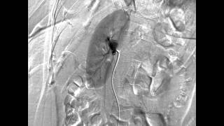 Aneurisma de Arteria Renal Derecha 2 de 9 [upl. by Eilssel]