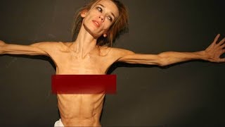 Thin  An Anorexia True Story  Anorexia Documentary TV [upl. by Yelsna]