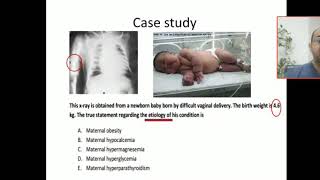 Case 69 complications of infant of diabetic mother IDM fracture humerus birth injuries brachial [upl. by Annahavas]