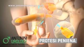 Disfunzione erettile  Antonini Urology Urologo amp Andrologo Roma [upl. by Yor]