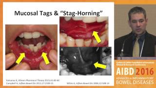 Extraintestinal Manifestations in Pediatric IBD Orofacial granulomatosis [upl. by Laurens]