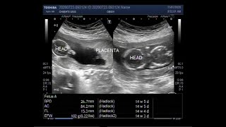 Ultrasound Video showing a miscarriage in the second trimester [upl. by Niletac]