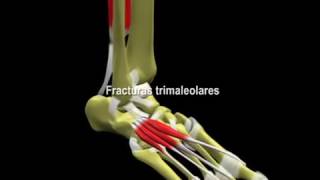 Fracturas del Tobillo [upl. by Notreve]