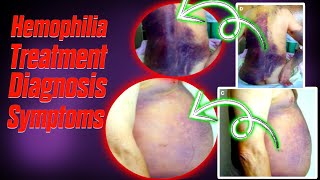 Hemophilia A  B  C  symptoms diagnosis and treatment [upl. by Notlimah]