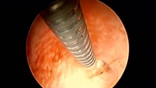 Vidéo  pose dun implant tubaire ESSURE unilatéral gauche sous hystéroscopie [upl. by Sisi311]