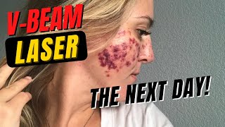 LASER DID THIS TO MY FACE Before and After Vbeam Laser Part 12 Simple Inna [upl. by Emyam]