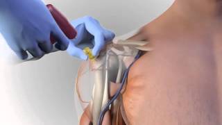 Arrow® EZIO® Proximal Humerus Site Animation [upl. by Akli5]