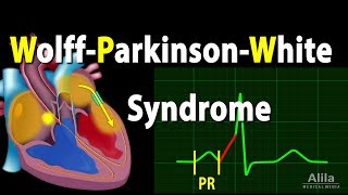 WolffParkinsonWhite Syndrome Pathophysiology PreExcitation and AVRT Animation [upl. by Brandon]