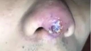 INFECTED NOSE TIP Cyst Removal Acne Extraction Video [upl. by Dukie]