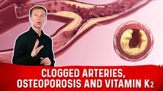 Clogged Arteries Osteoporosis and Vitamin K2 – Dr Berg [upl. by Mathe]