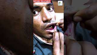 Oral Ulcer  Carcinoma oral Cavity से सही हुए मरीज की फीडबैक ulcer ulcertreatment homeopathy [upl. by Jemy]