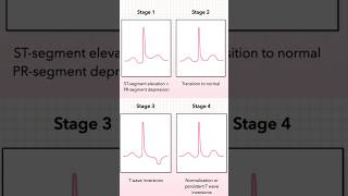 Acute Pericarditis ECG Stages 14 [upl. by Bartolome485]