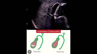 Acalculous cholecystitis  Gallbladder  Ultrasound  Radiology [upl. by Keller]