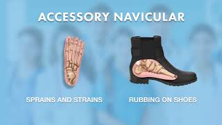 What is Accessory Navicular  Ask Dr Silverman [upl. by Blain151]