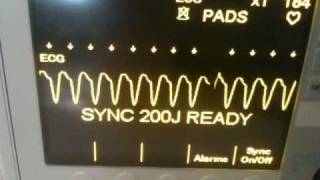 Ventricular Tachycardia cardioverted to Normal Sinus Rhythm per 2010 ACLS Guidelines [upl. by Tish]