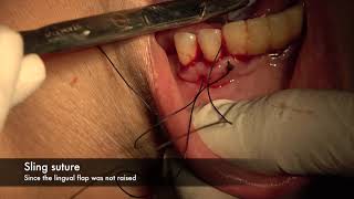 Treatment of a Periodontal Abscess [upl. by Levin]